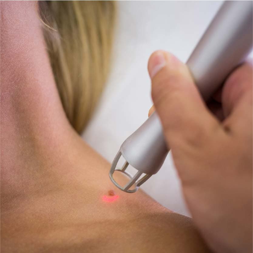 Mole Removal in Indore at Skintimacy