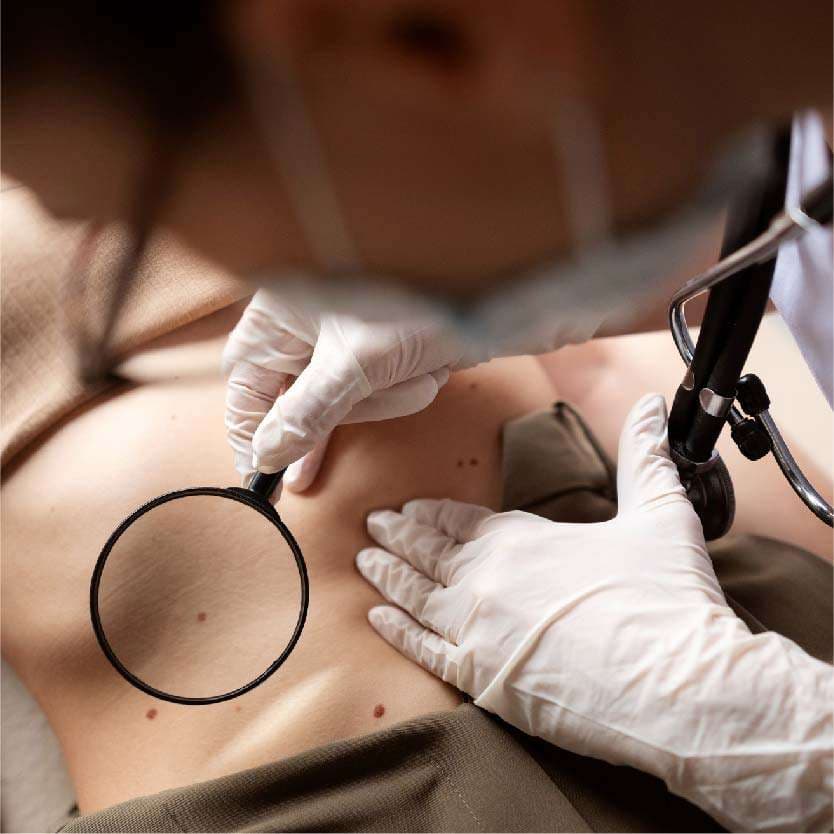 Scar Revision in Indore at Skintimacy