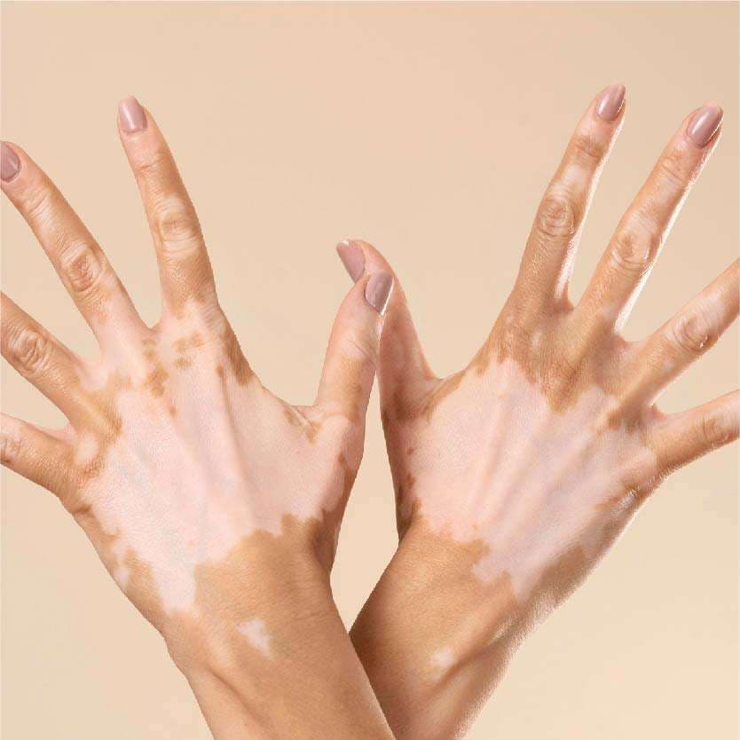 Vitiligo Surgery in Indore at Skintimacy